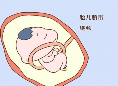 ​脐带绕颈和睡姿有关吗（孕妇睡姿会导致脐带绕颈吗）