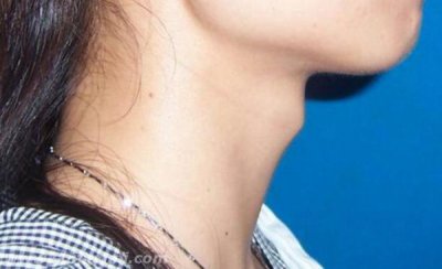 ​女性为什么有喉结?假如喉结明显是不是不正常