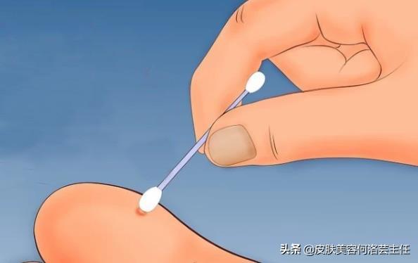 为什么会得疣（科普疣是什么为什么会长）(3)