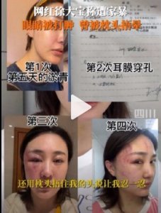 ​网红徐大宝资料实名举报被家暴 她丈夫是谁回应事件始末