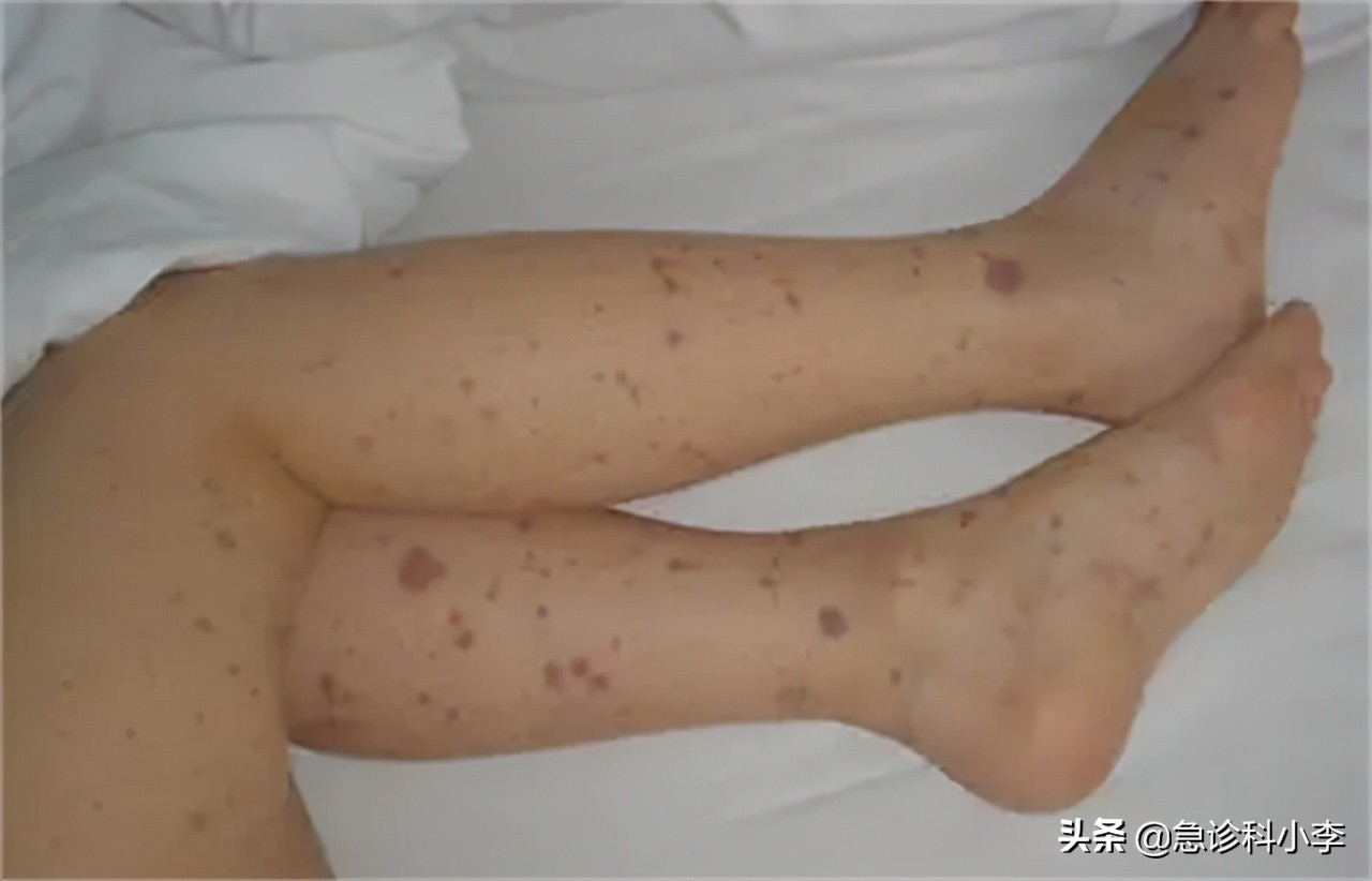 皮肤起红点是癌症的征兆吗（身上长红点是什么原因）