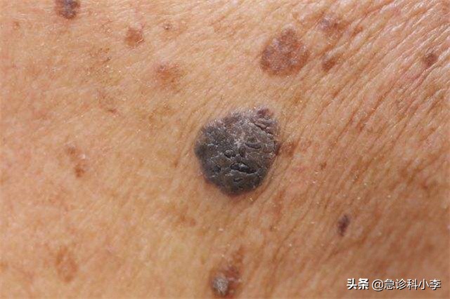 皮肤起红点是癌症的征兆吗（身上长红点是什么原因）