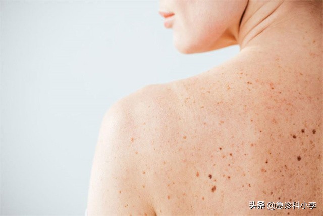 皮肤起红点是癌症的征兆吗（身上长红点是什么原因）
