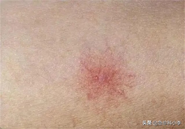 皮肤起红点是癌症的征兆吗（身上长红点是什么原因）
