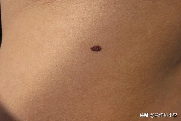 皮肤起红点是癌症的征兆吗（身上长红点是什么原因）
