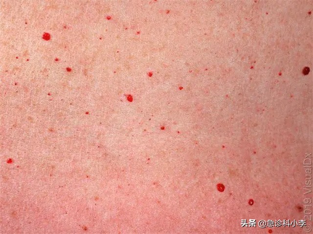 皮肤起红点是癌症的征兆吗（身上长红点是什么原因）