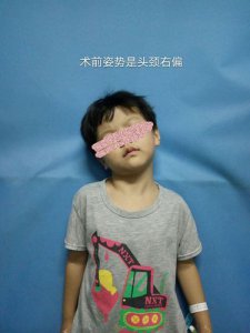 ​先天性肌斜颈能彻底治愈吗(先天性肌斜颈常见的并发症)