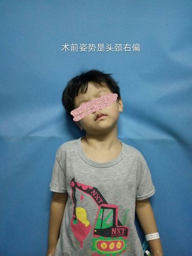 先天性肌斜颈能彻底治愈吗(先天性肌斜颈常见的并发症)-第1张图片-