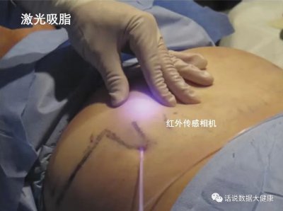 ​激光溶脂 又一个明星医美产品，效果如何？