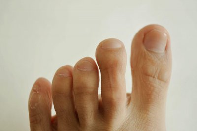 ​甲沟炎自己怎么处理 脚指甲长到肉里面，一走路就疼？自己在家如何应对？