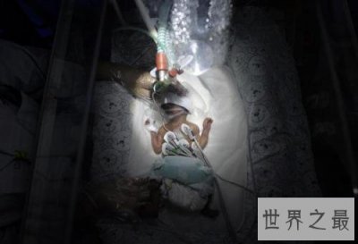 ​最小存活的婴儿，能活下来是个奇迹！