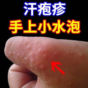​手指缝、脚趾缝、脚底长了像水泡一样的东西很痒是什么原因