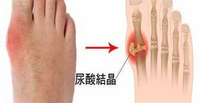 ​脚痛风是什么原因引起的（为什么你的痛风总是从脚开始痛起？难道你还不知道是