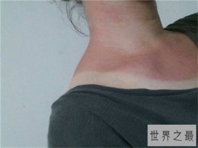 ​晒伤后怎么处理 简单的家用小窍门来解决