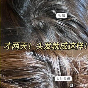 ​去屑洗发水哪种最有效？