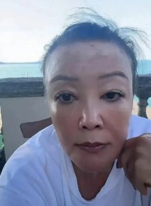 ​66岁张兰到意大利治白癜风，和汪小菲跨国直播