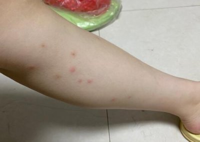 ​跳蚤咬后会起疙瘩吗