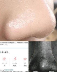 ​最好的去黑头方法(黑头小妙招)